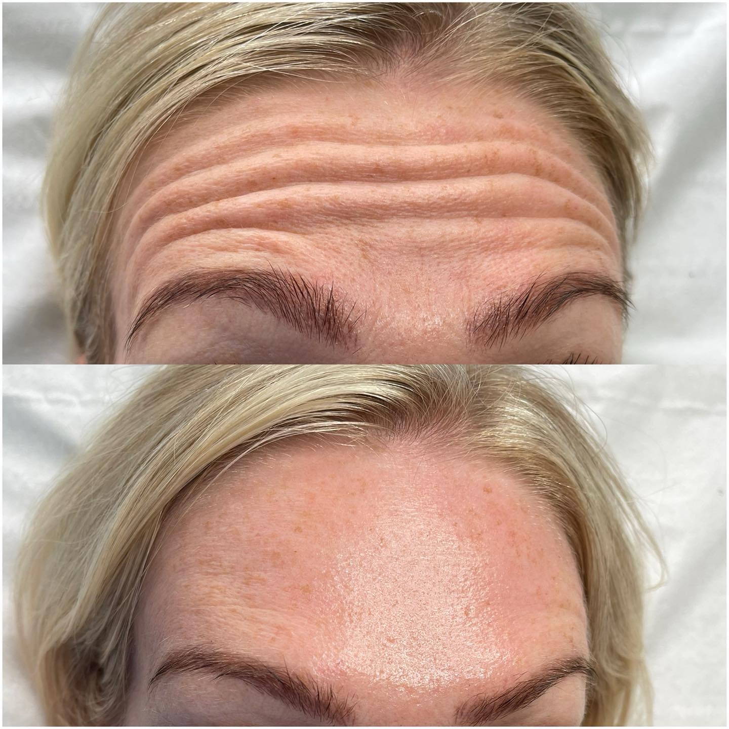 Anti Wrinkle Injections by Olyvine in Ormskirk