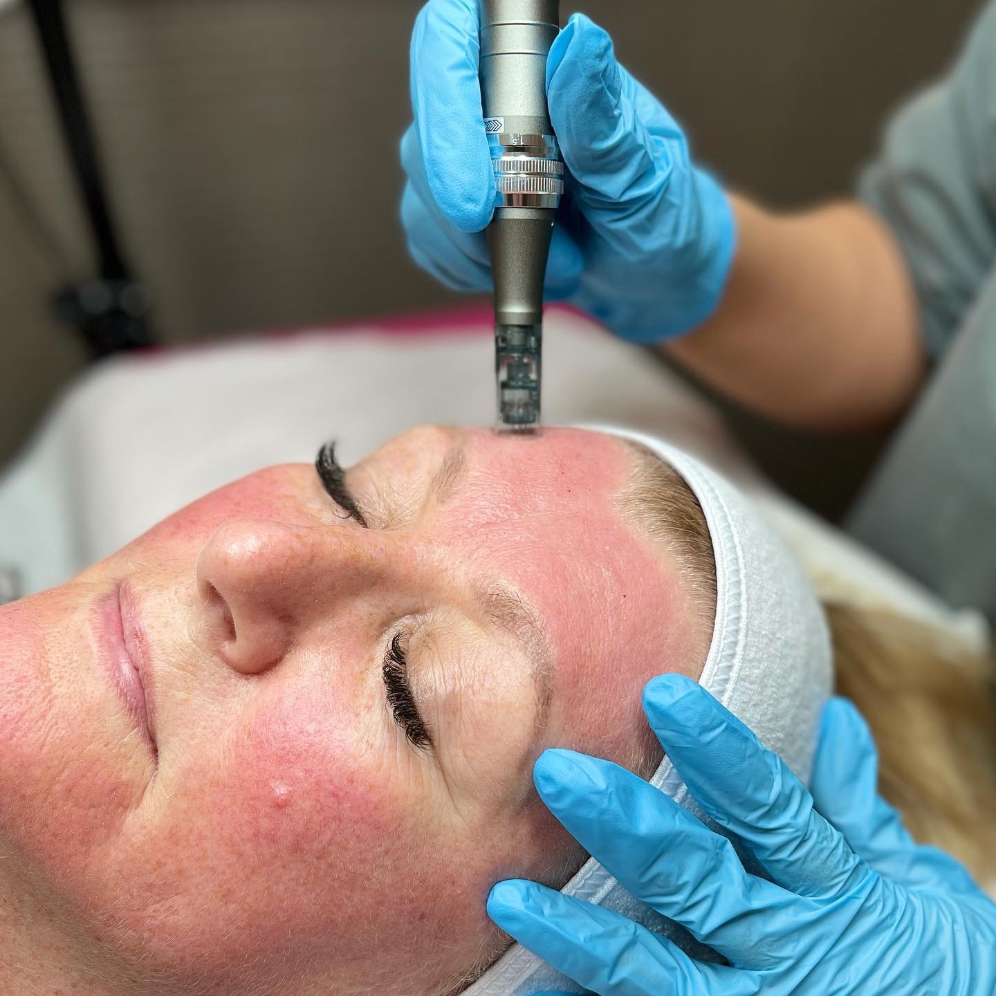 Microneedling by Olyvine in Ormskirk
