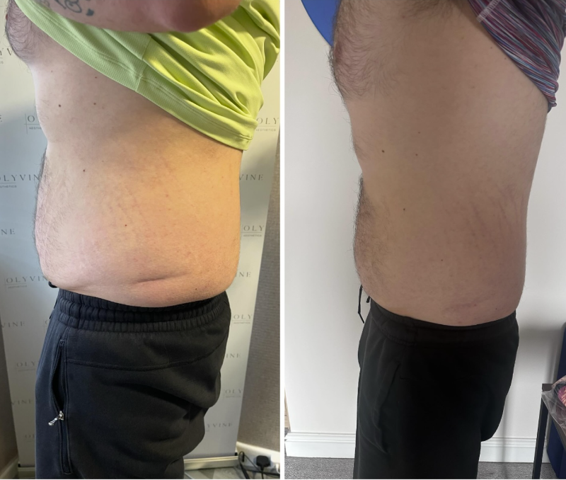 Fat Dissolving by Olyvine in Ormskirk