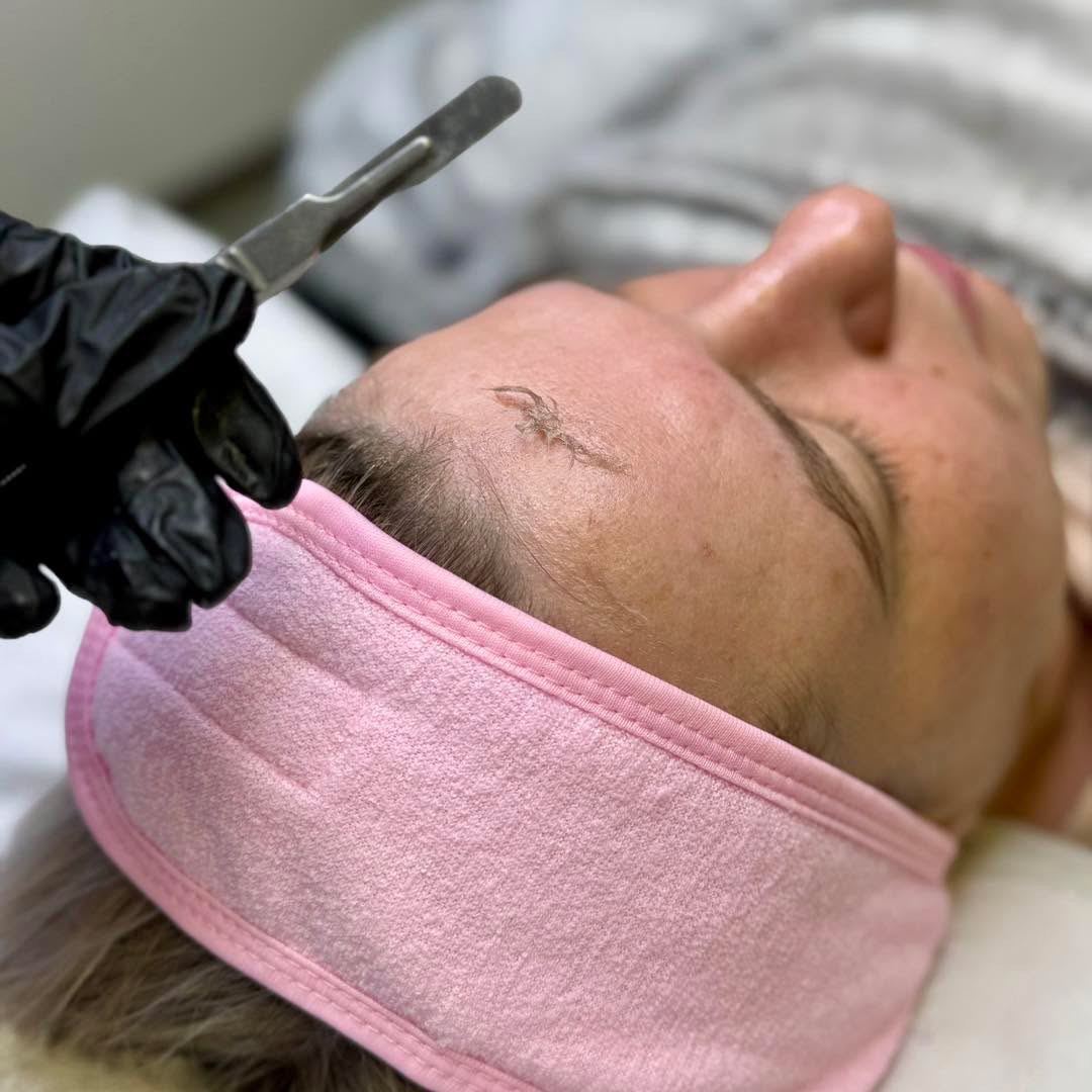 Dermaplaning by Olyvine in Ormskirk