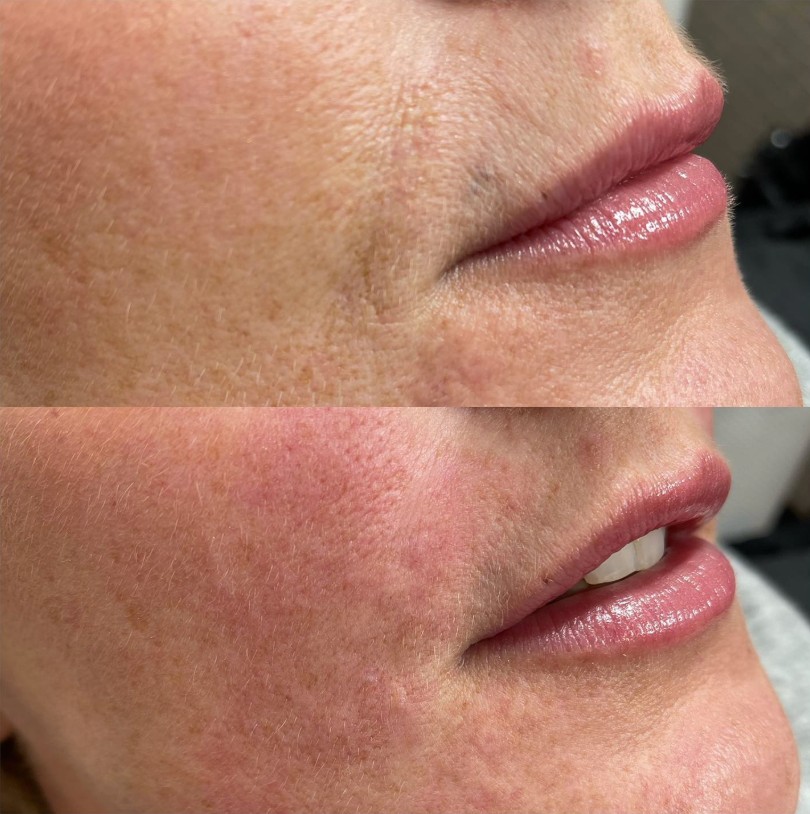 Skin Boosters by Olyvine in Ormskirk