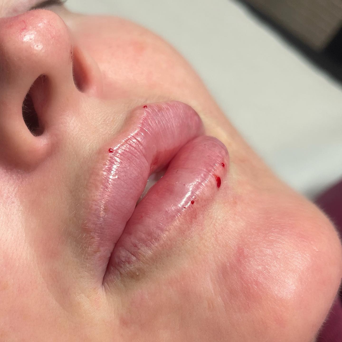 Dermal Fillers by Olyvine in Ormskirk